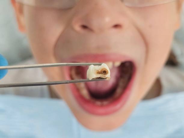Best Emergency Dental Care for Broken or Chipped Teeth in Rockford, IL