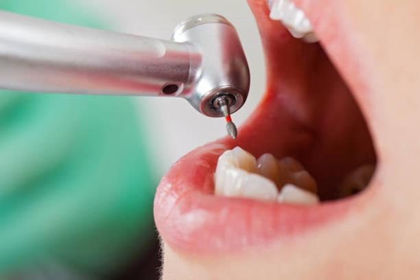 Best Emergency Treatment for Dental Infections or Abscesses in Rockford, IL
